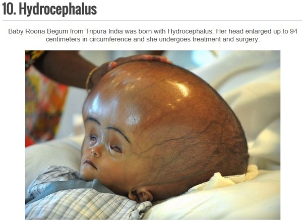 10 Terrifying Rare Birth Diseases That You've Never Heard Of