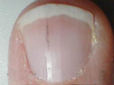 how to get healthy fingernails fingernail treatment for healthy nails how to grow healthy toenails
