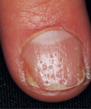 nails health pics of fingernail health problems fingernail health indicator pics nail indicators of health