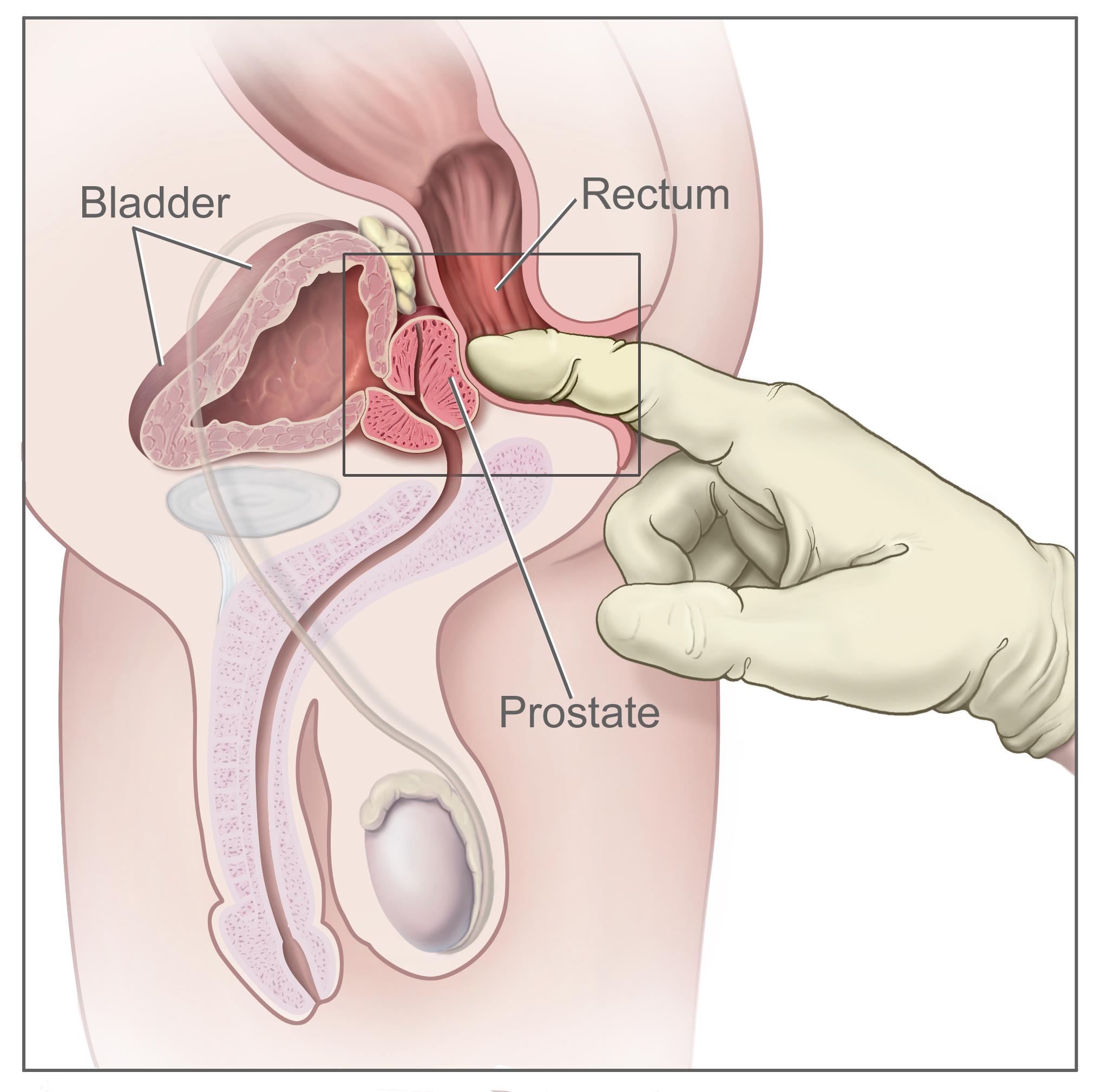  symptoms of prostate cancer stage 2 symptoms of prostate cancer are symptoms of prostate cancer are similar to symptoms of prostate cancer after prostatectomy