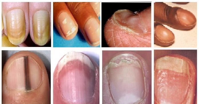 12 Changes In Your Fingernails That Could Signal Other ...