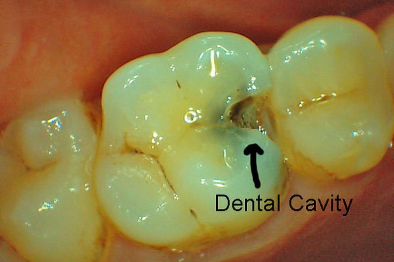 an you get rid of cavities naturally